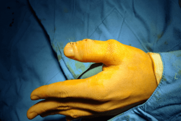 Phẫu thuật dị tật ngón tay cái đôi ở bệnh nhân 13 tuổi